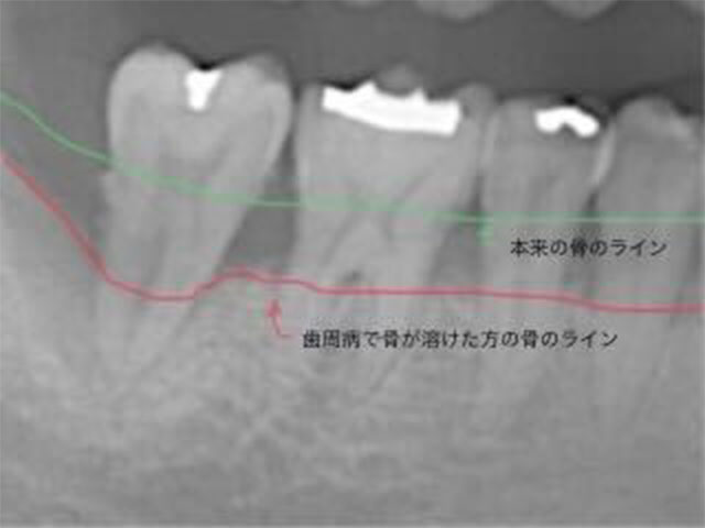 骨が溶けていて縁下歯石が付着している状態