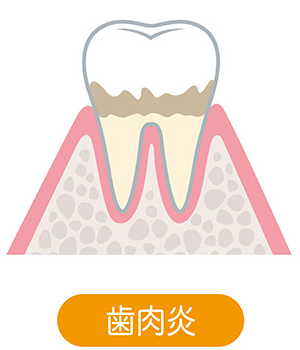 歯と歯茎間に歯垢がたまる