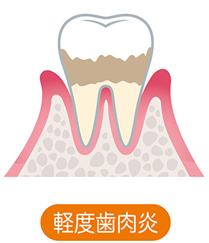 歯茎が赤くなり腫れて歯磨きで出血することがある