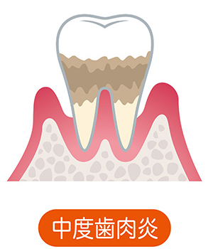 歯槽骨が溶けて後退してきます