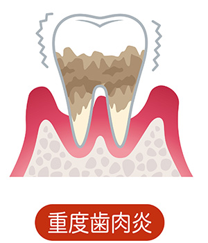 歯槽骨で歯を支えられなくなります