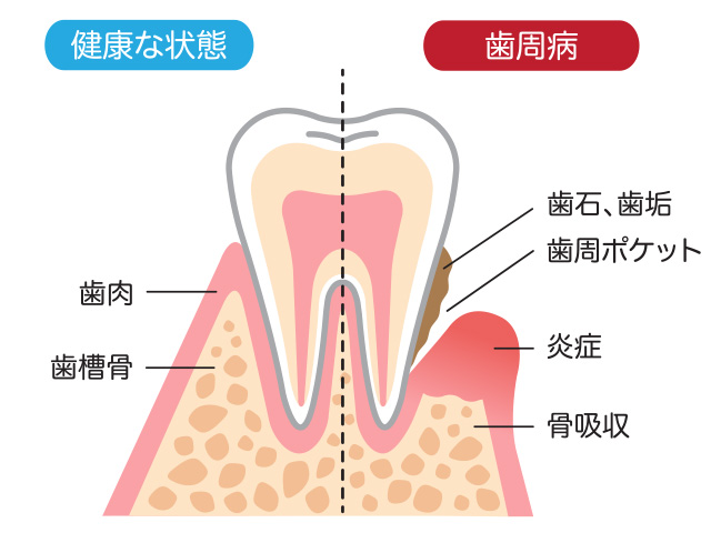 歯周病の原因は